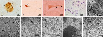 Common Fatal Neurodegenerative Diseases Revisited: Beyond Age, Comorbidities, and Devastating Terminal Neuropathology There Is Hope With Prevention